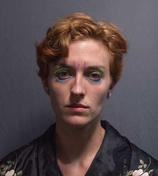 The lower eyelid furrow is marked here in blue, the eyecover fold in green, and the glabella in purple.