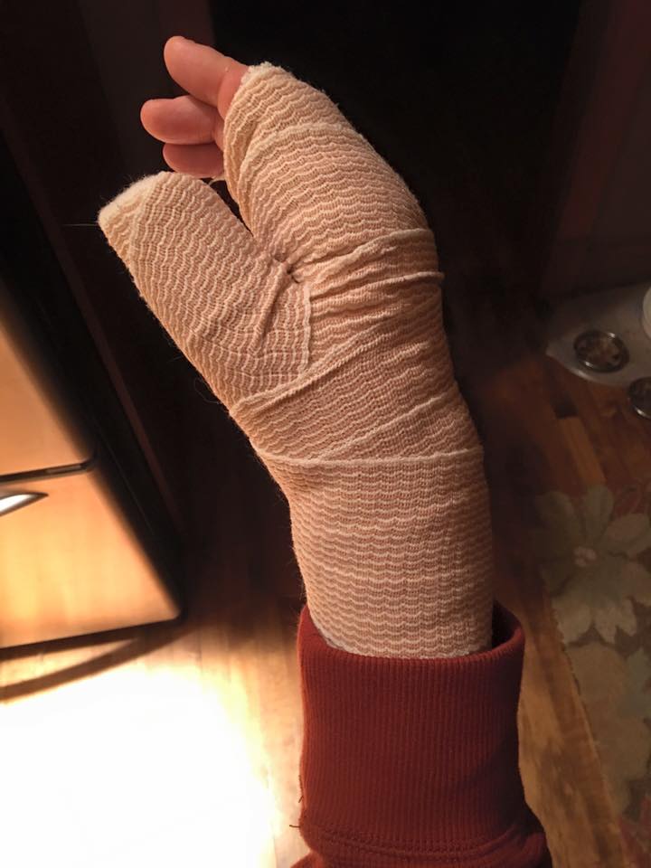 My right hand bandaged after returning from the ER.