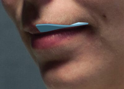 An illustration of the "twisting" orientation of the upper lip toward the corners of the mouth.